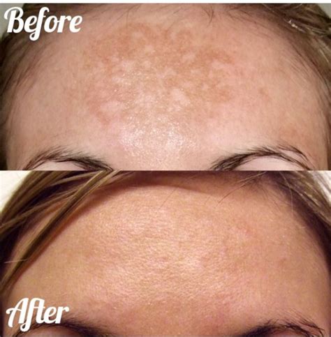 Microdermabrasion before and after pictures Offered at Incleanse Www ...