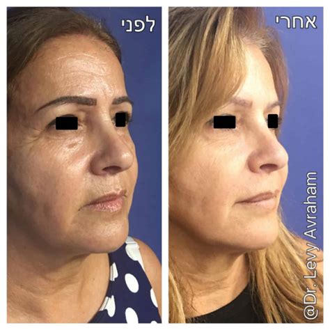 hyaluronic-acid-injection-before-after | ד"ר לוי אברהם