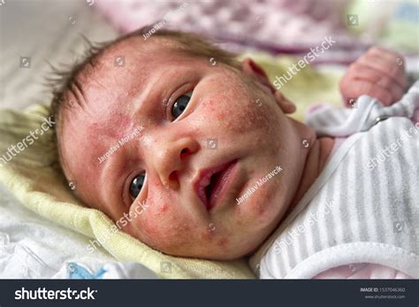 Newborn Acne Neonatorum On Baby Face Stock Photo 1537046360 | Shutterstock