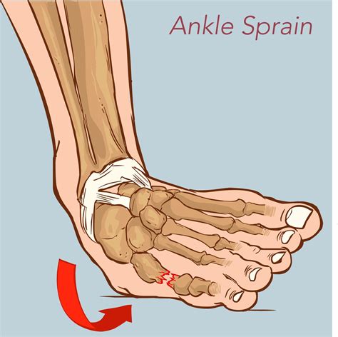 Home Treatment Sprained Ankle - Homemade Ftempo