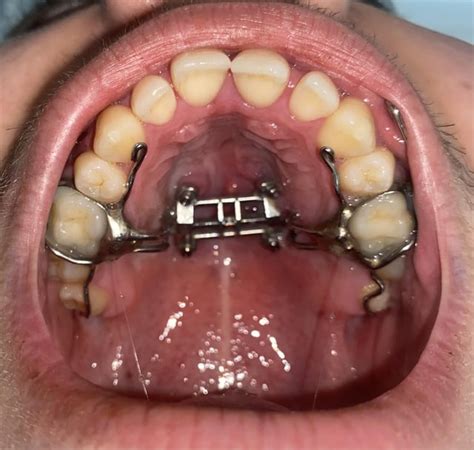 Before and After MSE : r/orthotropics