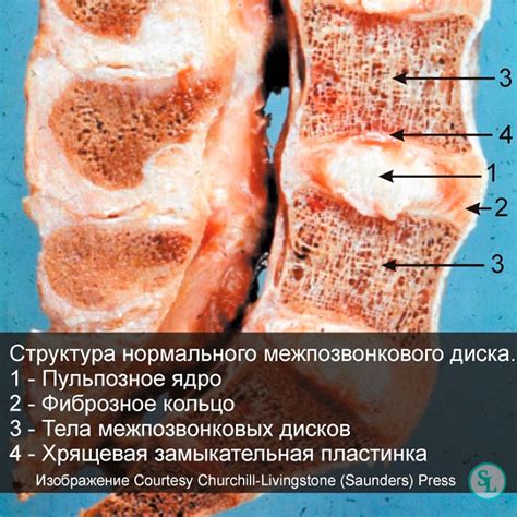 Протрузии что это такое и опасно ли