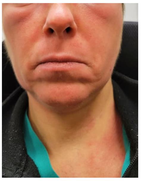 Neuropsychiatric Manifestations of Mast Cell Activation Syndrome and