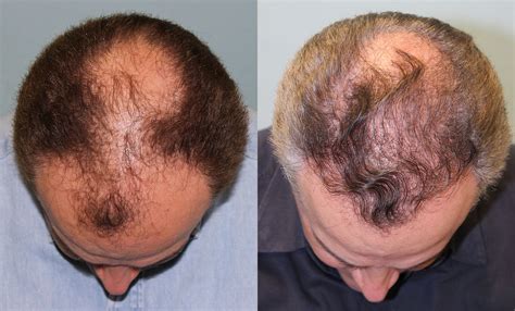 hair transplant years    recession years   hair
