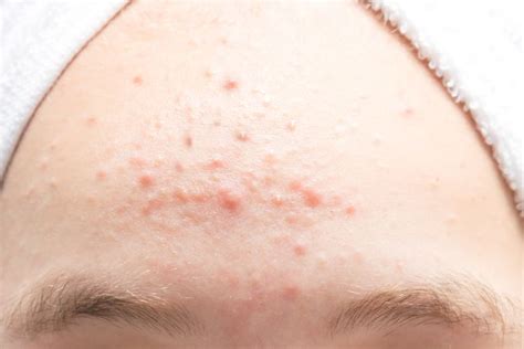 foto  obat alami  mengatasi berbagai penyakit kulit