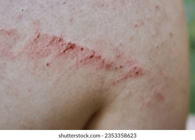 Skin Excoriation Royalty-Free Images, Stock Photos & Pictures | Shutterstock