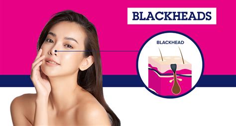 What Causes Blackheads on Your Nose? | Biore Skincare