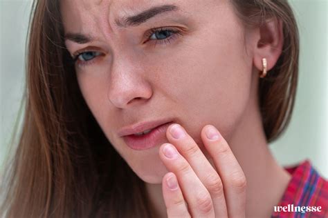 cold sore  canker sore wellnesse