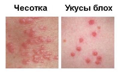Чесотка: симптомы, фото, лечение. Как лечить чесотку