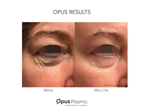 Facial Skin Resurfacing | Opus Plasma