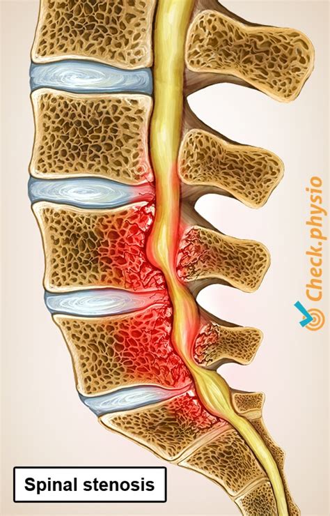 Lumbar Spinal Stenosis Classification