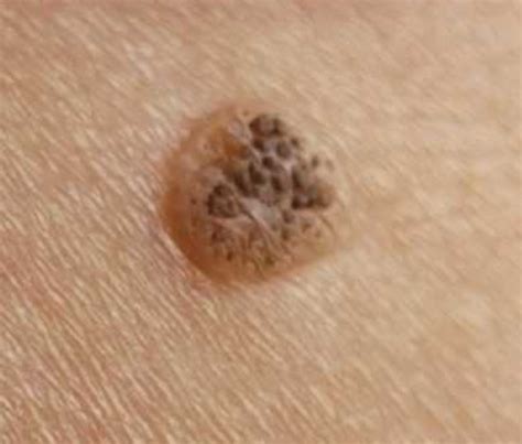 Is this a keratosis? : r/keratosis