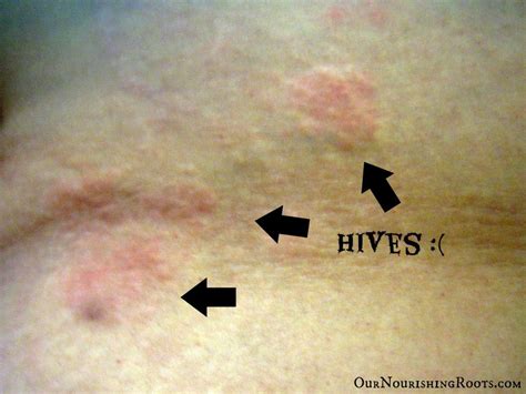 hives Herbal Remedies, Home Remedies, Natural Remedies, How To Treat ...