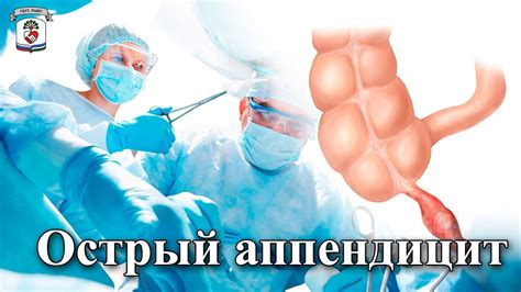 "На приеме у врача" Выпуск 36 - Острый аппендицит - YouTube