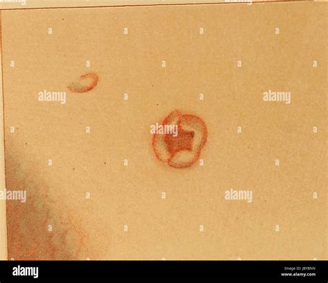 Venereal Diseases High Resolution Stock Photography and Images - Alamy