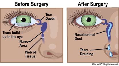 surgery  tear duct blockage nemours kidshealth