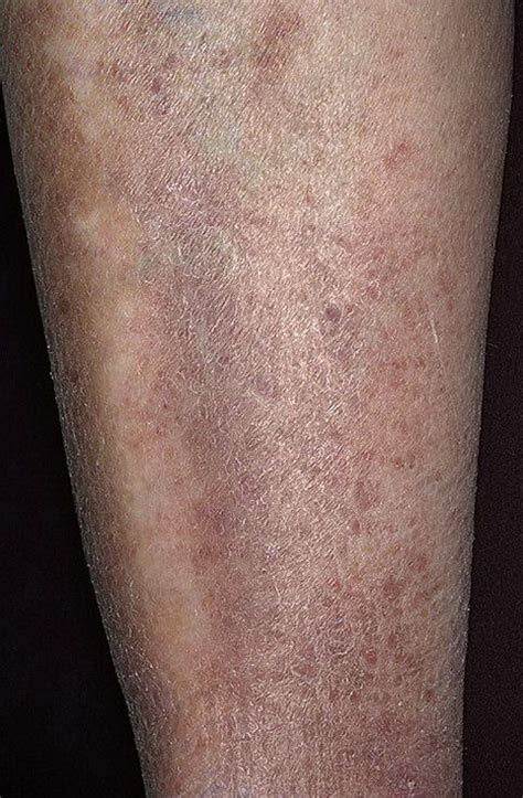 Варикозная экзема фото – 174 шт. / fotodiagnoz.com
