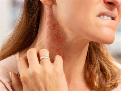 Skin Rash Types That Itch at Kimberly Knox blog