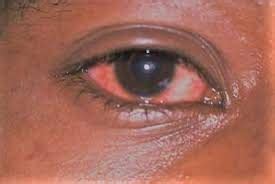 Acute Hemorrhagic Conjunctivitis (Apollo/Pink Eye) - Health Essentials