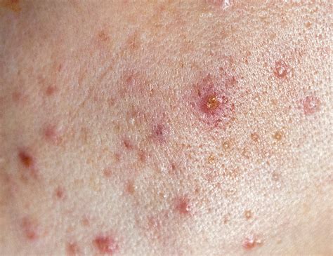 Everything To Know About Acne-Prone Skin – Prequel