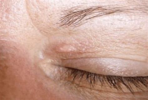 Xanthelasma | Healthium Clinics