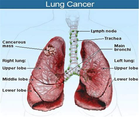 Stage 4 Cancer Lung | MedicineBTG.com