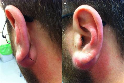 abscess earlobe  james engel blog