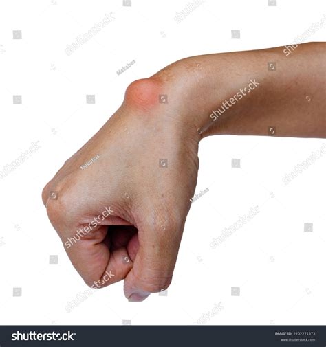 Ganglion Cyst Wrist Ganglion Cyst Pain Stock Photo 2202271573