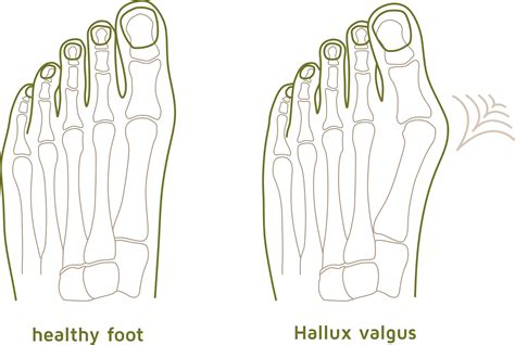 Hallux – Schuhfabrik A. Hickersberger GmbH & Co KG