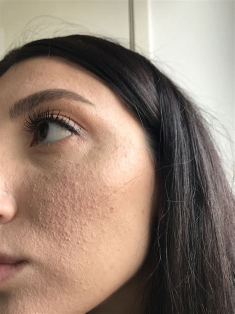 Pityrosporum Folliculitis – Acne – Acne.org Forum