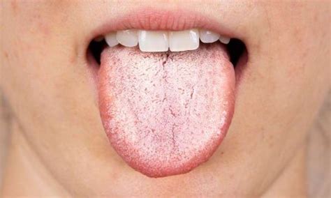Why Is My Tongue White? What Is White Tongue?