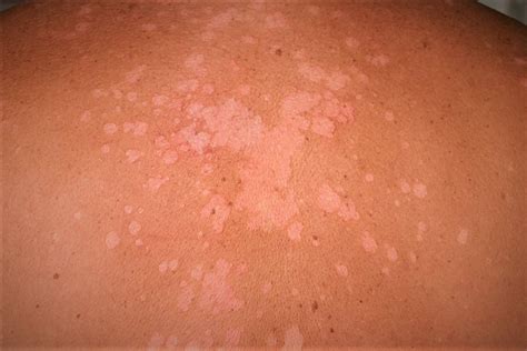 Pityriasis versicolor, causes, symptoms, diagnosis, treatment & prognosis