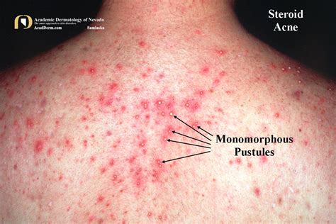 Acne Medicamentosa: A Side Effect of Medicines - Academic Dermatology ...