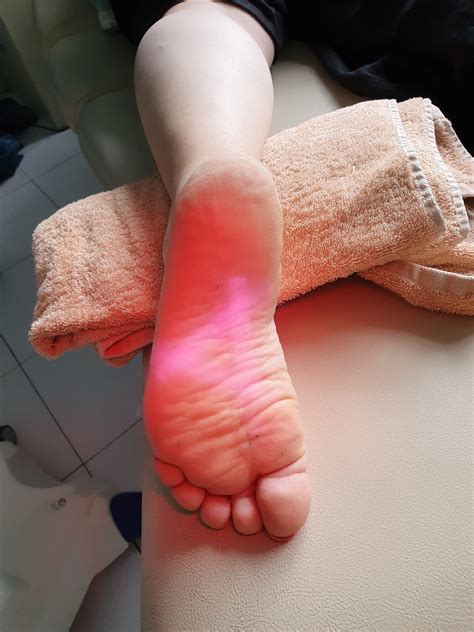 Webinar: Optimise Plantar Fasciitis Recovery with Advanced Therapies