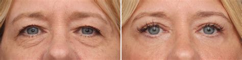 Lower Eyelid Surgery Photos | Philadelphia, PA | Patient 3703