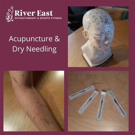 The Differences Between Dry Needling vs. Acupuncture? | River East ...