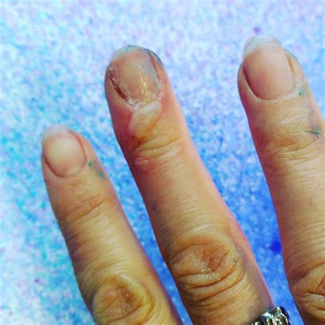 should you pop a blister from a burn - Good News Flux