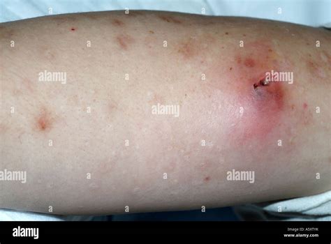 staph infection  skin comment soigner staphylococcus aureus cactpz