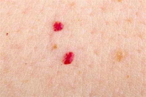 Красные родинки на теле, причины с фото и как избавиться
