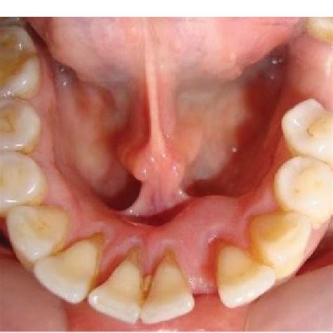 Clinical photograph showing the location of the cystic lesion ...