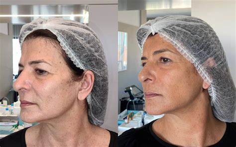 Morpheus Rosto Antes E Depois