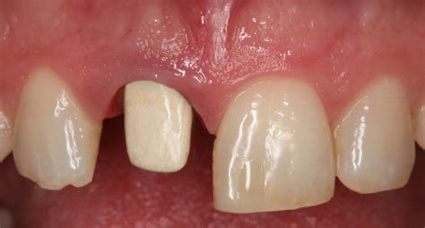 metal ceramic post core  crown  maxillary central incisor fororg
