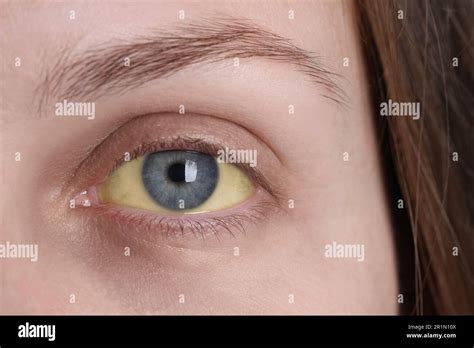 Woman with yellow eyes, closeup view. Symptom of hepatitis Stock Photo ...