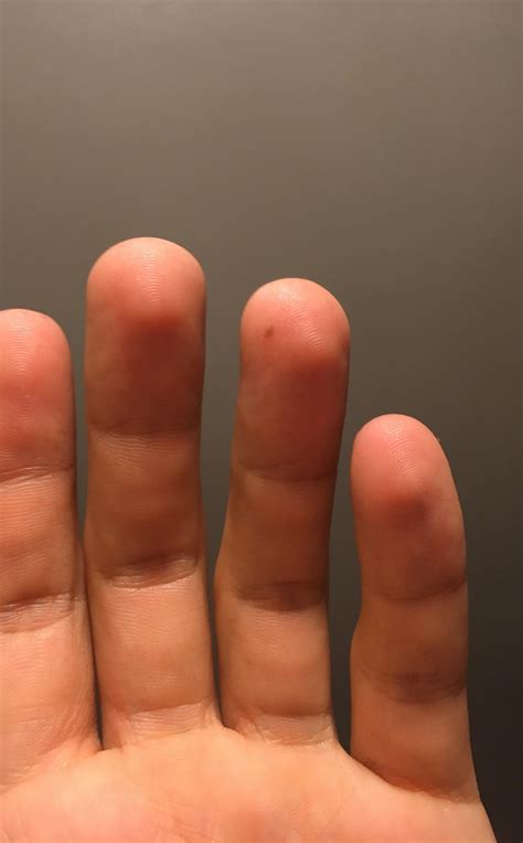This freckle that recently appeared on my finger and makes it look