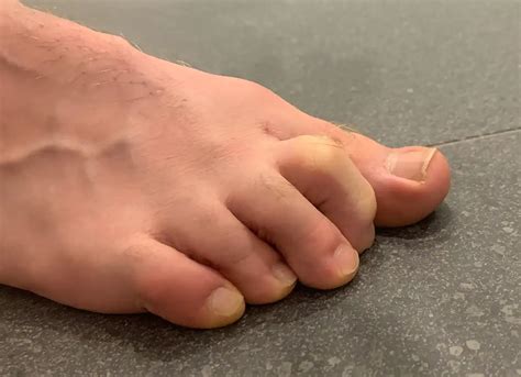 Claw toe : neurological causes of this deformation | Podexpert