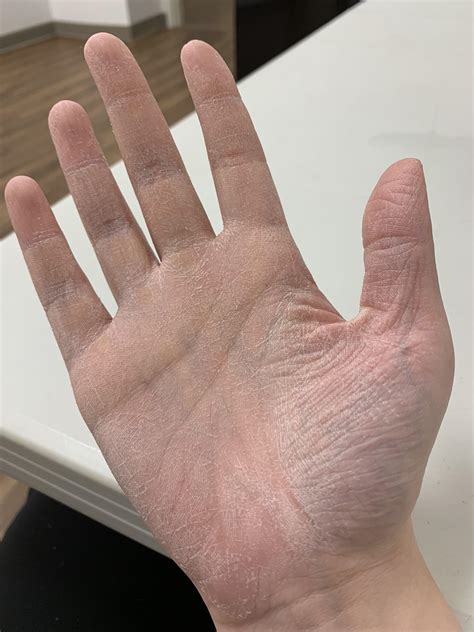 Extremely dry, peeling hands. I’ve tried almost every hand cream, and