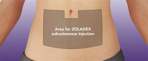 dosing  administration zoladex goserelin implant