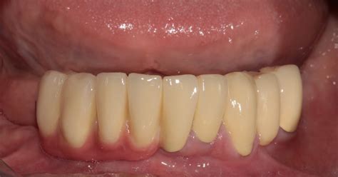 Стоматолошка протетика | Dentizar
