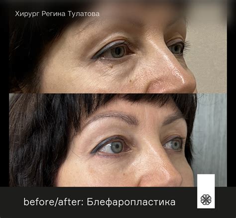 Блефаропластика