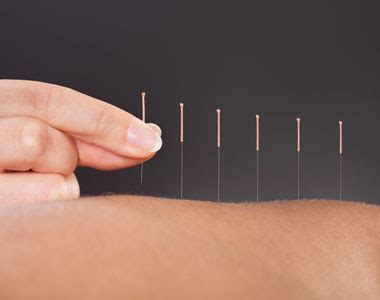 Acupuncture | TCM Acupuncture in Miami